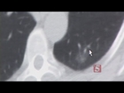 $49 Lung CT Scan May Reveal Cancer Growths
