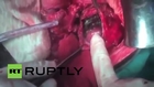 India: Foetus of unborn parasitic twin removed from man's stomach *GRAPHIC*