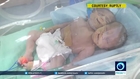 Conjoined twins with two heads and one body born in Gaza