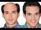 how to regrow hair at home - how to regrow hair follicles - regrow hairline