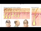 JK Laser Hair Therapy video Laser for treating hair loss and thinning hair and to regrow hair