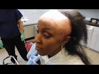 Traction Alopecia  |  Hair Transplant Costs from Natural Transplants