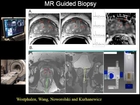 UCSF Radiology: BODY RIG Research - Treatment of Prostate Cancer
