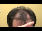Frontal Bald Hair Loss Restoration Surgery Los Gatos Near San Jose CA Dr. Diep www.mhtaclinic.com