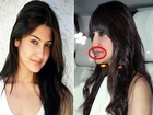 Anushka Sharma's Lip Job | Cosmetic Surgery In Bollywood