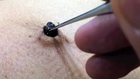 The Biggest Blackhead  Umbolith？ Belly button lint